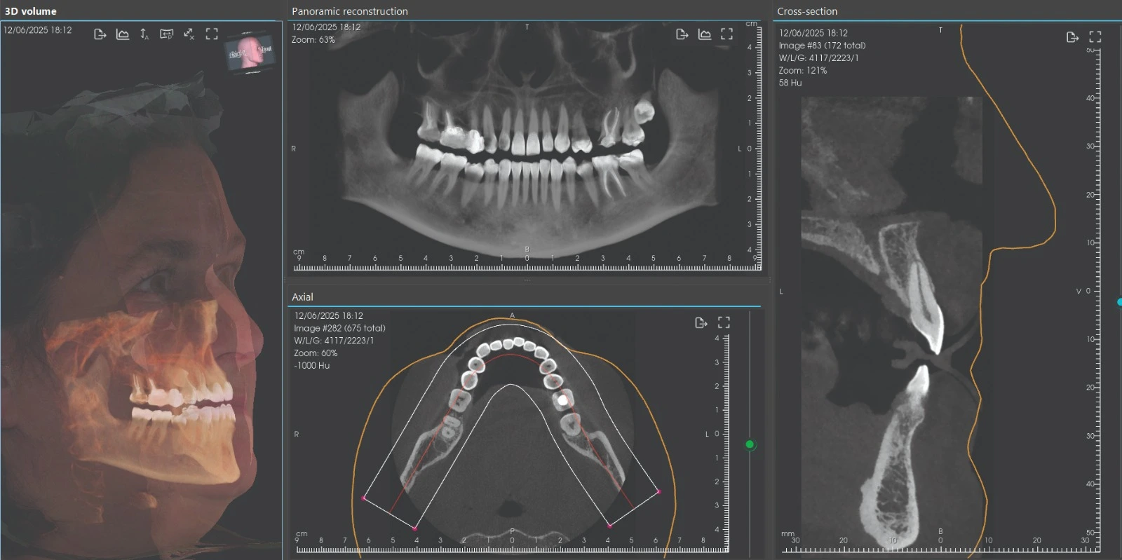 dental cbct machine scan