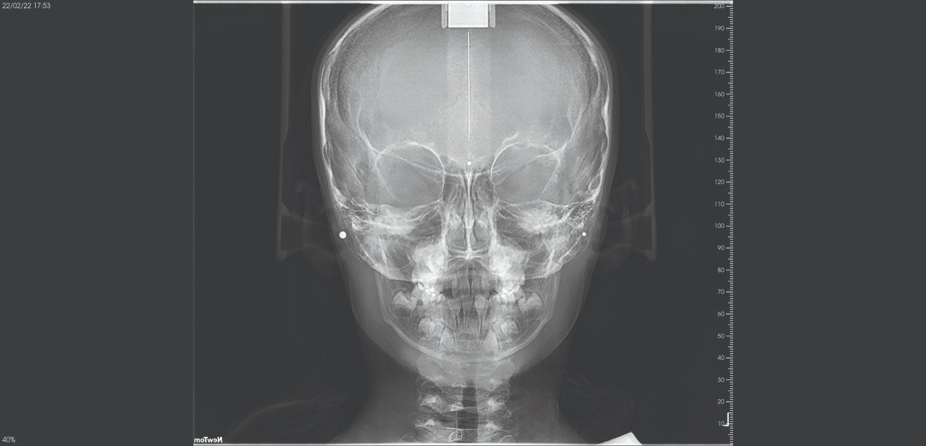 dental cbct macine skull